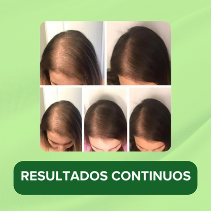 OUHOE | Spray Para El Crecimiento Natural del Cabello 100% Efectivo